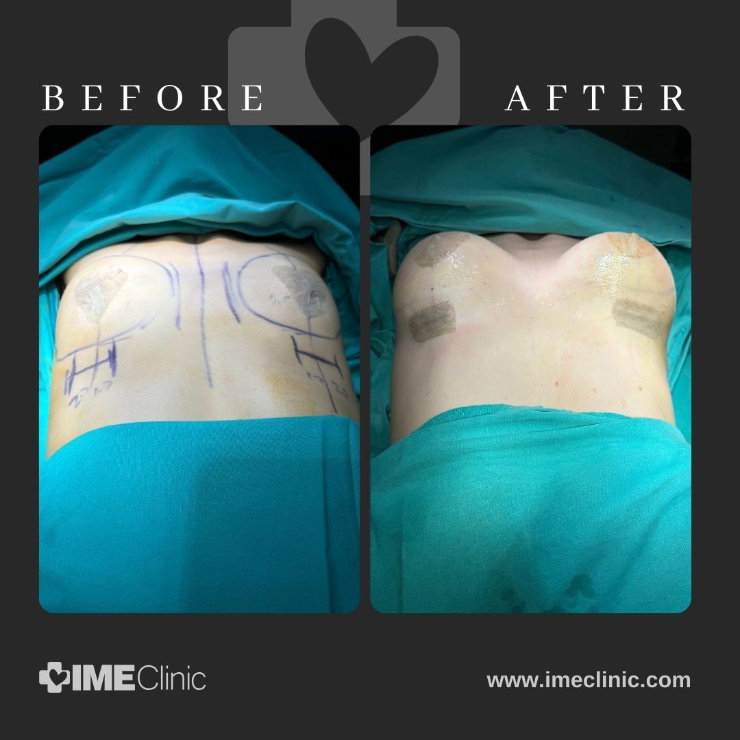 
                                Side-by-side images showcasing a breast lifting procedure. The left displays pre-operation markings on the patients chest, while the right reveals post-operation results with bandages. Text reads Before and After, and IME Clinic is prominently shown at the bottom.